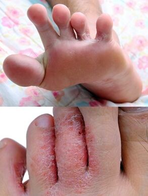 The mushroom of the foot