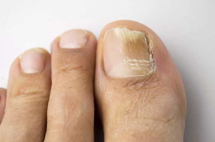 Mikosu of the nail on the foot