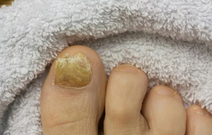 Nail trunk