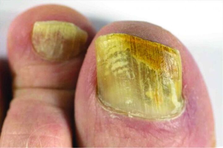 The feeling of the nail on the leg